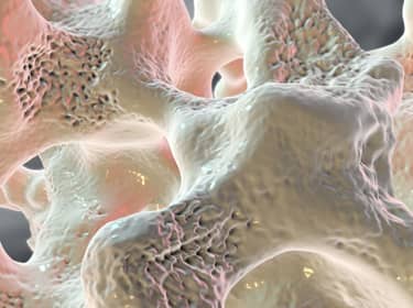 De foto toont een schematische weergave van een verzwakt bot