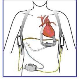 De illustratie toont een lichaam met een permanent steunhart van het type Left Ventricular Assist Device (LVAD)