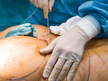 De foto toont het proces van lipofilling bij de plastisch chirurg