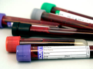 De foto toont verschillende gekleurde buisjes met bloed van mensen met paroxysmale nachtelijke hemoglobinurie